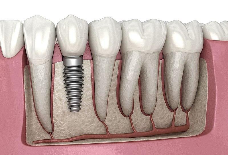 Dental Implants: Restoring Your Smile and Confidence: Niyati Sheth, DDS:  General, Cosmetic and Family Dentist