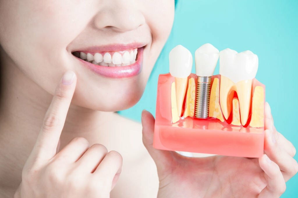 Dental Implants Procedure: What To Expect During The Treatment - Paloma  Family Dental