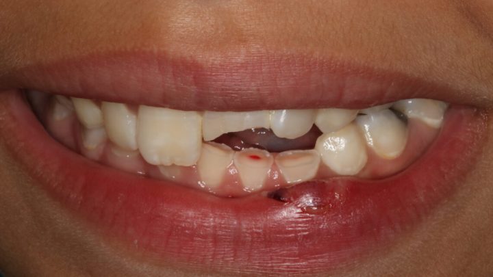 Trauma Dental: Proteja Seu Sorriso! Saiba Como Prevenir e Tratar Lesões Bucais