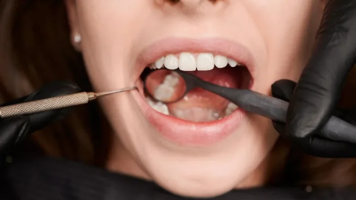 Compreendendo as Dentaduras: Um Guia Completo para Restaurar o Seu Sorriso