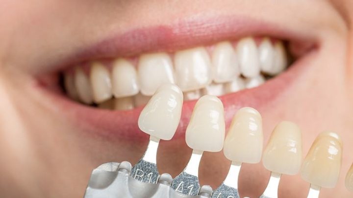 Lentes Odontológicas: Cuidados Essenciais para Manter um Sorriso Perfeito