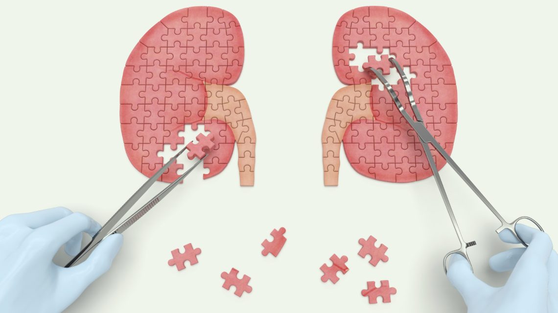 Como é Realizado um Transplante Renal com Sucesso em 2024: Guia Completo