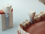 Razões pelas quais você precisa de implantes dentários