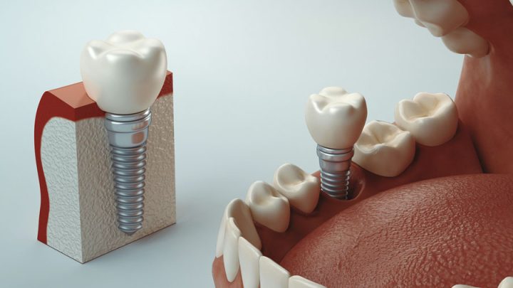 Razões pelas quais você precisa de implantes dentários