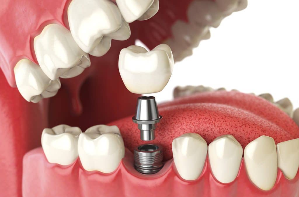 Razões pelas quais você precisa de implantes dentários