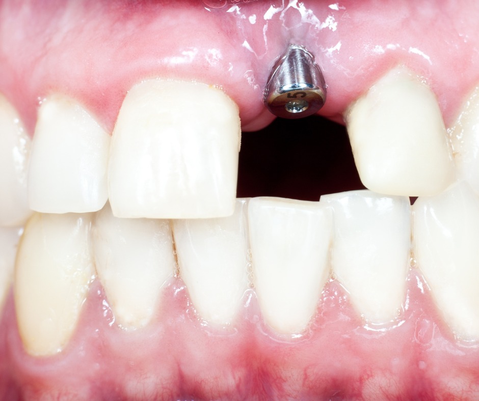 Razões pelas quais você precisa de implantes dentários