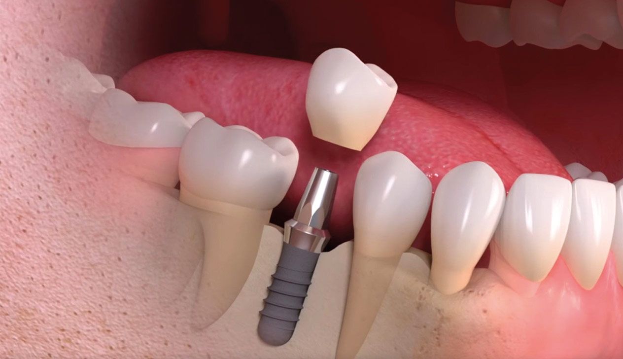 Razões pelas quais você precisa de implantes dentários